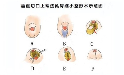 缩胸手术 缩胸手术