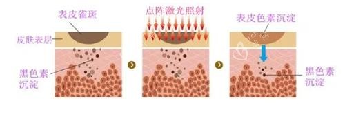 点阵激光的成效 点阵激光的成效