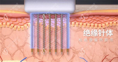 黄金微针针头图解