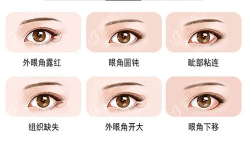 北京客莱美舍整形眼角手术 北京客莱美舍整形眼角手术
