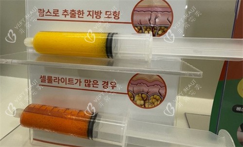 韩国365mc医院lams吸脂
