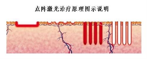 点阵激光的原理 点阵激光的原理