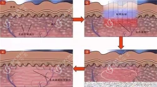 光子嫩肤的步骤 光子嫩肤的步骤