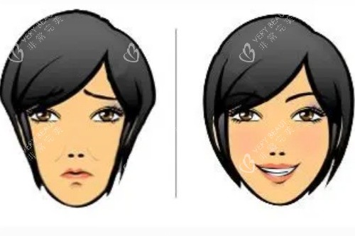 蘋(píng)果肌填充對(duì)比圖 蘋(píng)果肌填充對(duì)比圖