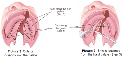 唇裂修复图片一览