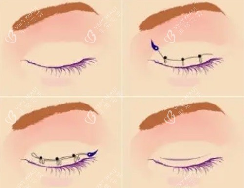 雙眼皮手術(shù)示意圖