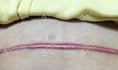 疤痕增生 疤痕增生