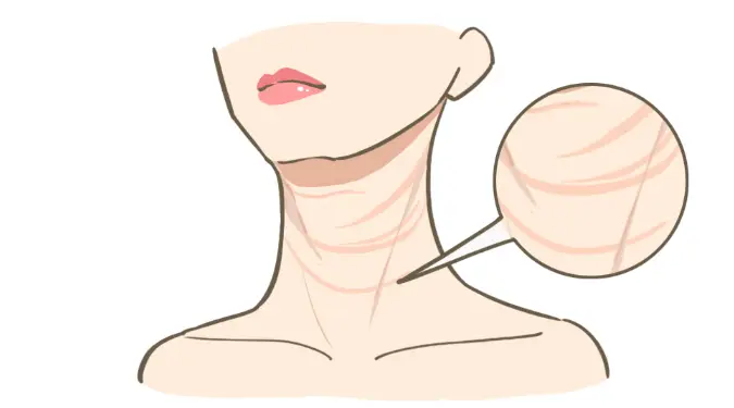 頸部皺紋 頸部皺紋