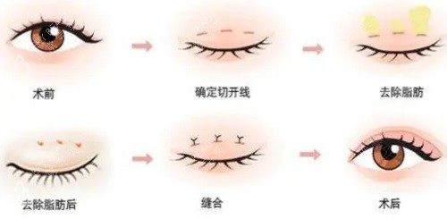 雙眼皮手術(shù)過程圖