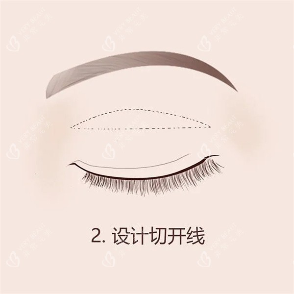 双眼皮手术 双眼皮手术