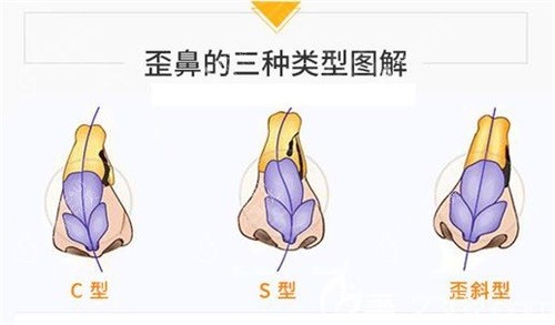 歪鼻的三種類型圖解 歪鼻的三種類型圖解