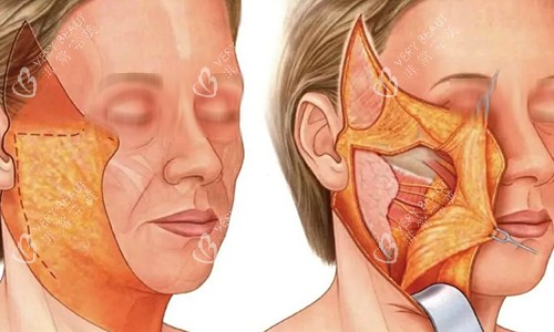 拉皮手術(shù)過(guò)程動(dòng)畫(huà)示意圖 拉皮手術(shù)過(guò)程動(dòng)畫(huà)示意圖