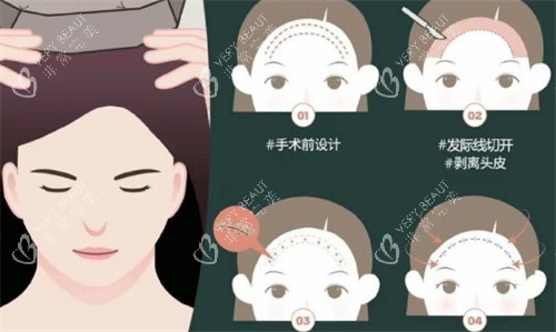 額頭縮小手術(shù)過程 額頭縮小手術(shù)過程