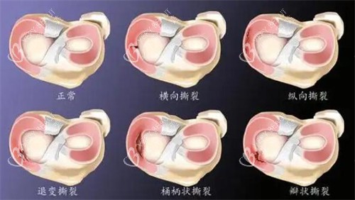 半月板损伤展示照片图