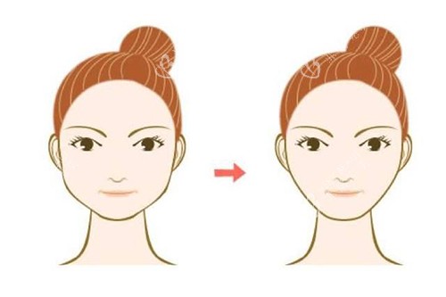 面部吸脂对比示意图