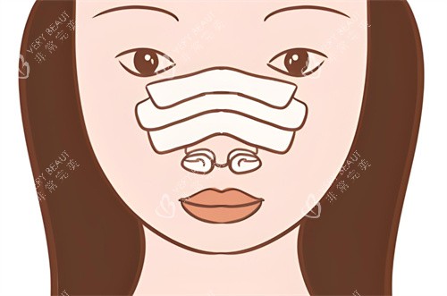 隆鼻修复术后图