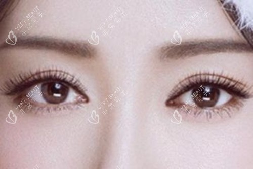 割双眼皮 割双眼皮