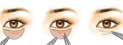 内切法祛眼袋的手术步骤 内切法祛眼袋的手术步骤