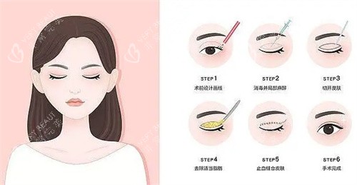 全切双眼皮过程卡通图 全切双眼皮过程卡通图