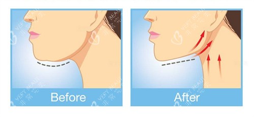 下巴提升紧致整形前后对比图 下巴提升紧致整形前后对比图