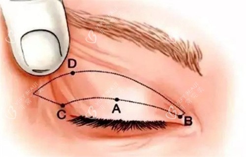 全切双眼皮术前设计 全切双眼皮术前设计