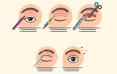 埋线双眼皮过程卡通图 埋线双眼皮过程卡通图