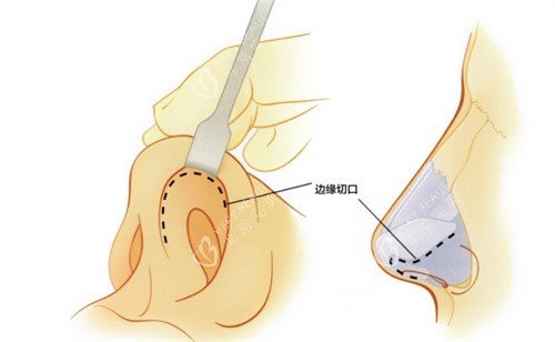 隆鼻手术的切口 隆鼻手术的切口