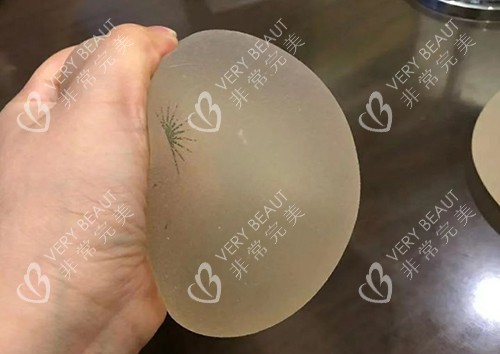 丰胸手术傲诺拉璀璨揉捏展示图