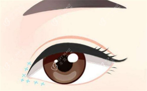 眼综合手术后眼部的样子