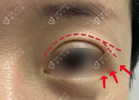 双眼皮眼尾开叉 双眼皮眼尾开叉