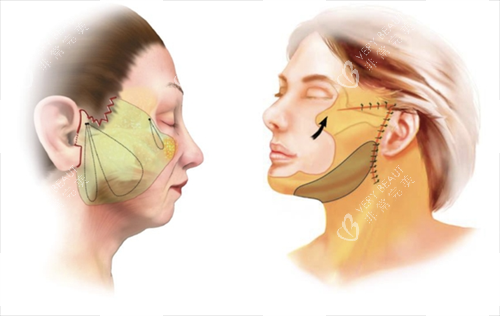 拉皮手术面部脂肪组织区域圈画图 拉皮手术面部脂肪组织区域圈画图