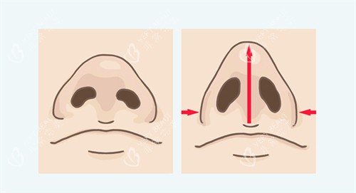 鼻翼缩后鼻子挺拔 鼻翼缩后鼻子挺拔