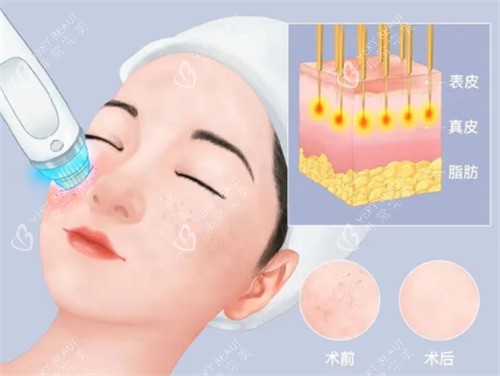 黑曜双波黄金微针治疗层次 黑曜双波黄金微针治疗层次