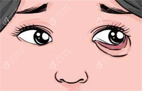 下眼睑外翻 下眼睑外翻