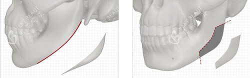 下颌角手术 下颌角手术