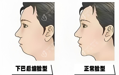 下巴后缩与正常脸型对比动画图