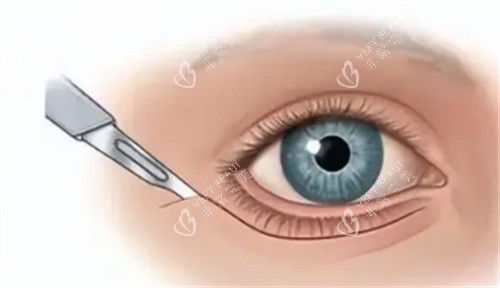 眼周筋膜提升切口