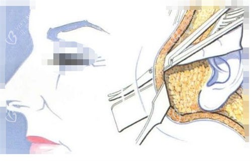 拉皮手术手术剖面图 拉皮手术手术剖面图