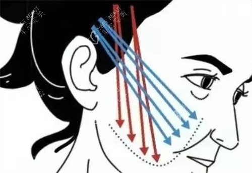 中下面面部提升的位置