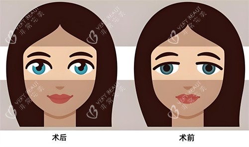 双眼皮术后术前对比动画图 双眼皮术后术前对比动画图