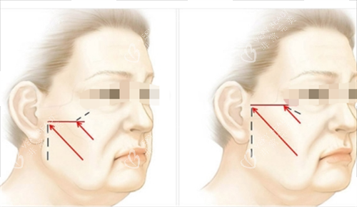 中上面部拉皮提拉方向画线图