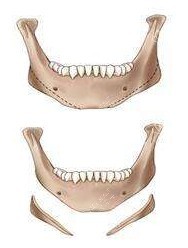 下颌角手术变化图 下颌角手术变化图