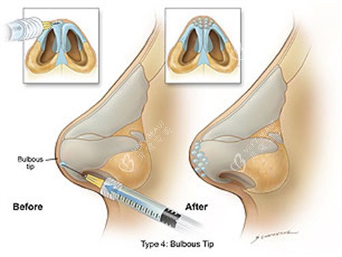 玻尿酸注射隆鼻 玻尿酸注射隆鼻