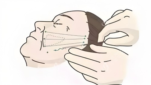 埋线提升图示 埋线提升图示