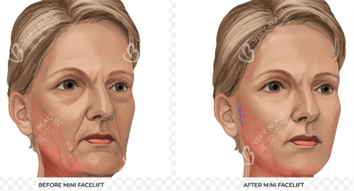 改善皮肤皱纹的面部提升
