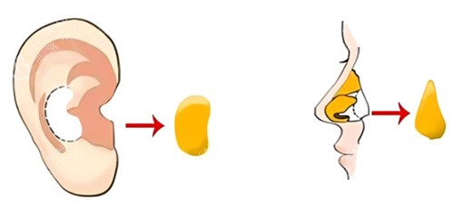 隆鼻耳软骨图示 隆鼻耳软骨图示