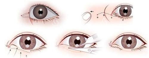 开眼角手术方法 开眼角手术方法
