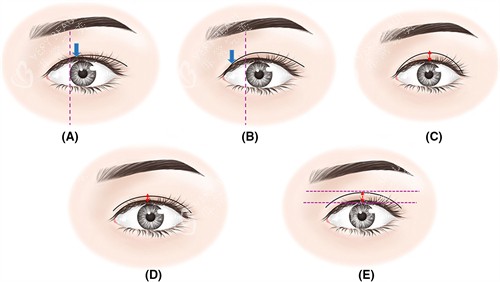 调整双眼皮宽度 调整双眼皮宽度