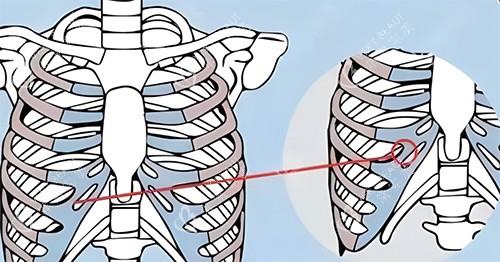 隆鼻肋骨鼻所用肋骨图