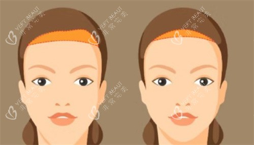 额头缩小手术对比 额头缩小手术对比